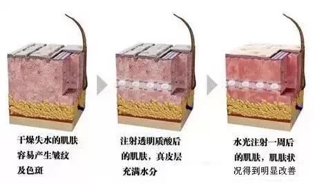 水光针多久打一次 假如水光针坚持打了4次之后
